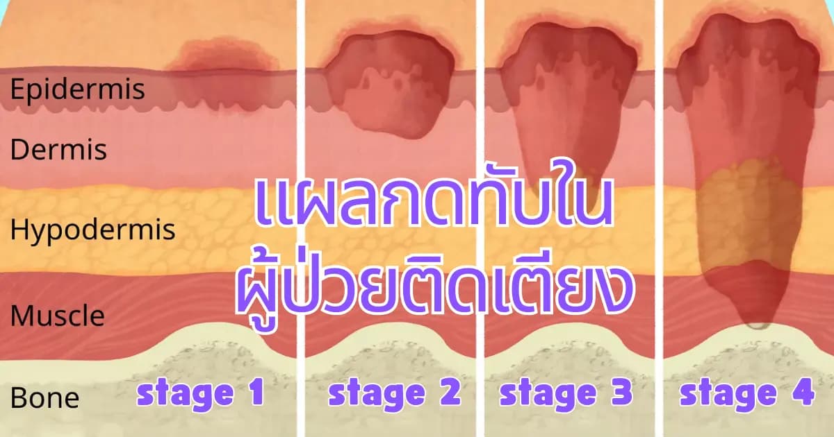 การดูแลผู้ป่วยติดเตียงที่มีแผลกดทับ: วิธีป้องกันและรักษา