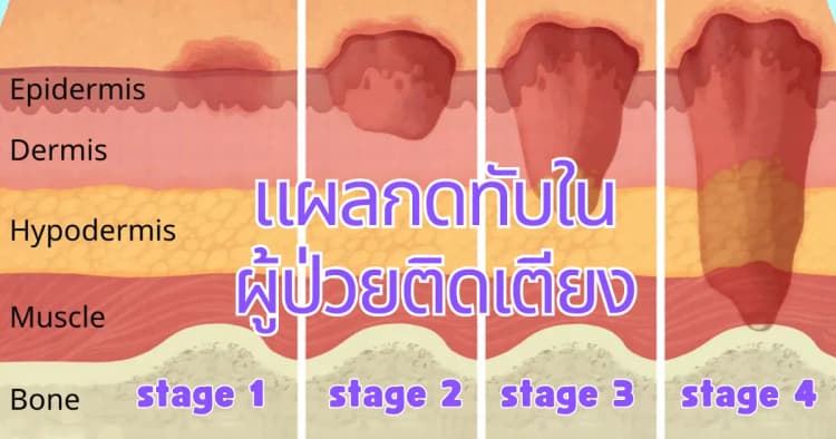 การดูแลผู้ป่วยติดเตียงที่มีแผลกดทับ: วิธีป้องกันและรักษา